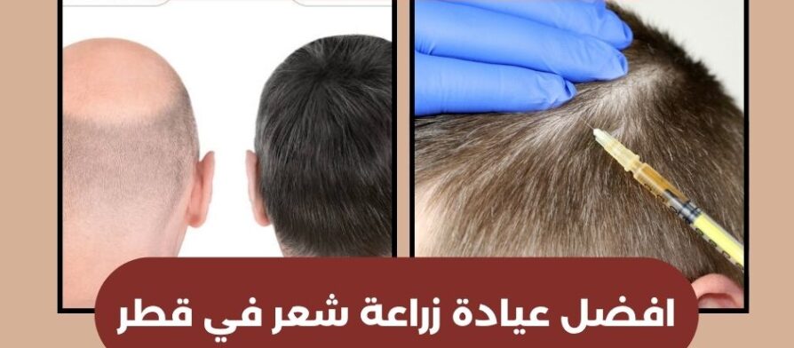 افضل عيادة زراعة شعر في قطر