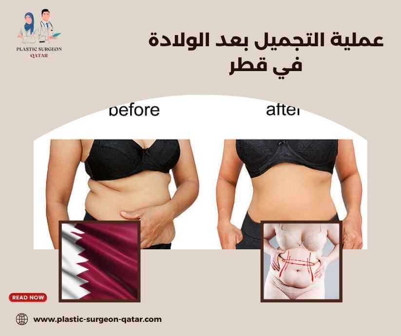 عملية التجميل بعد الولادة في قطر