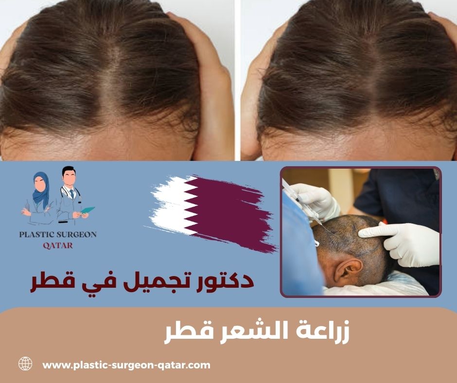 مركز زراعة الشعر قطر