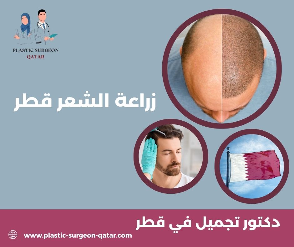 زراعة الشعر قطر