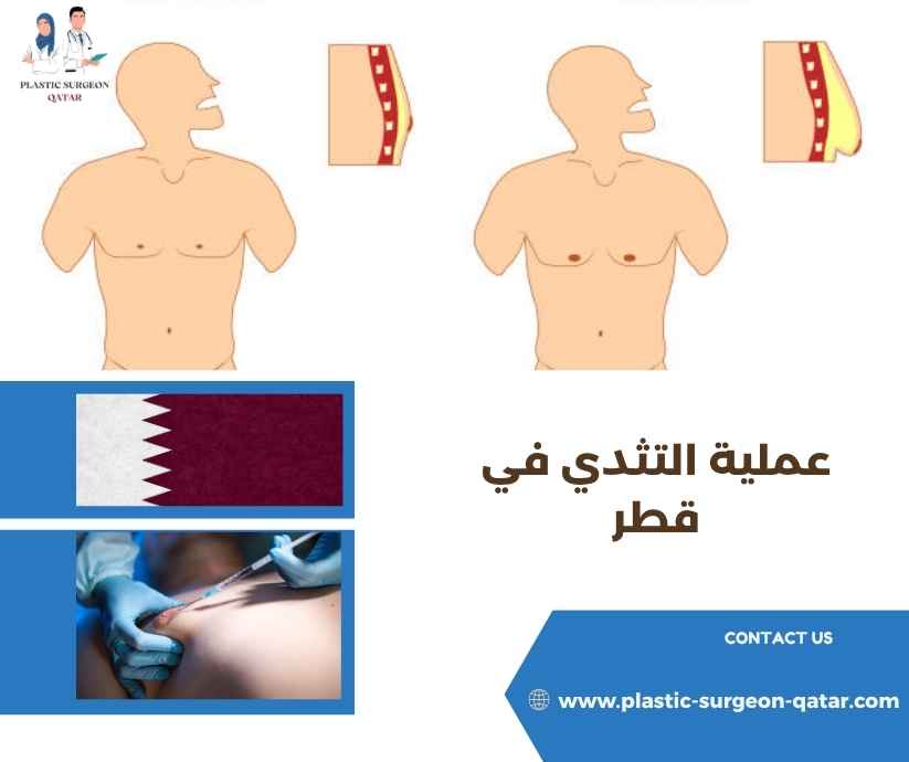 عملية التثدي في قطر
