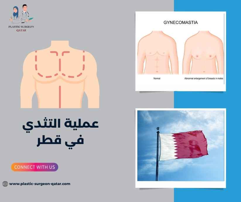 عملية التثدي في قطر