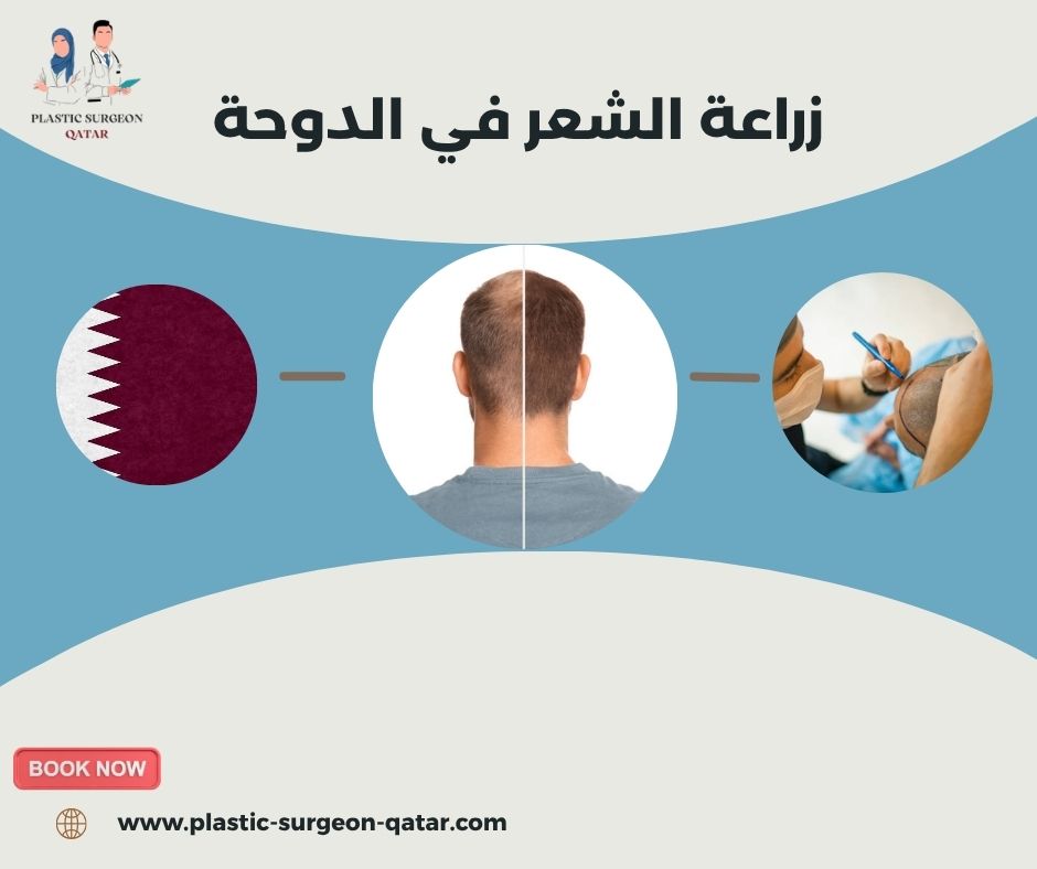 زراعة الشعر في الدوحة