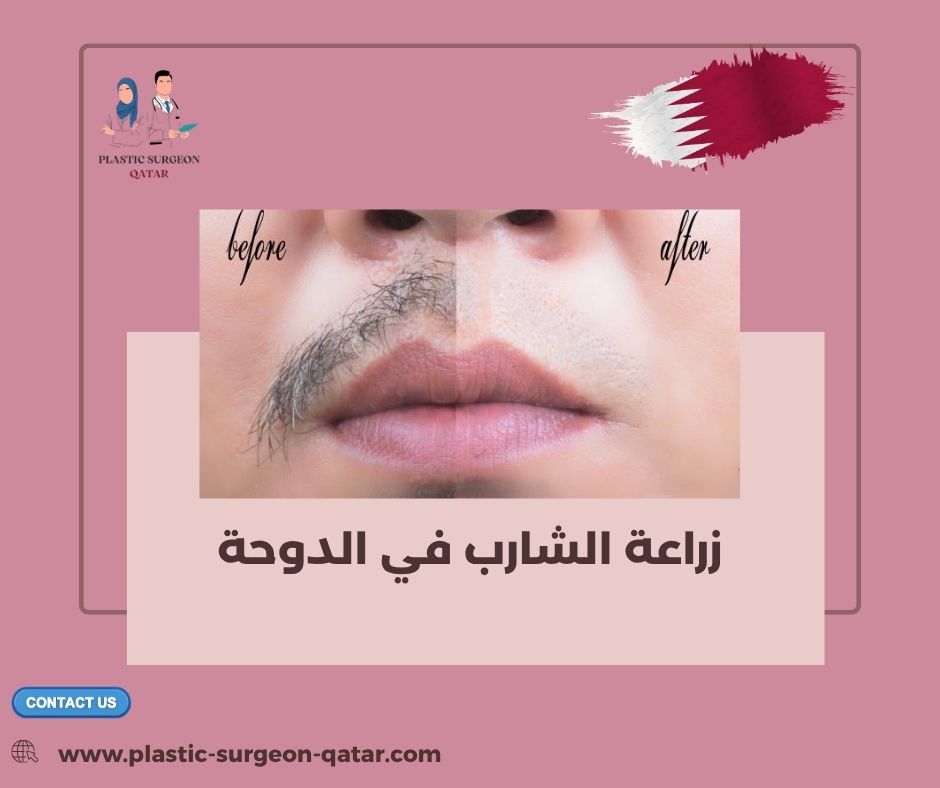 زراعة الشارب في الدوحة
