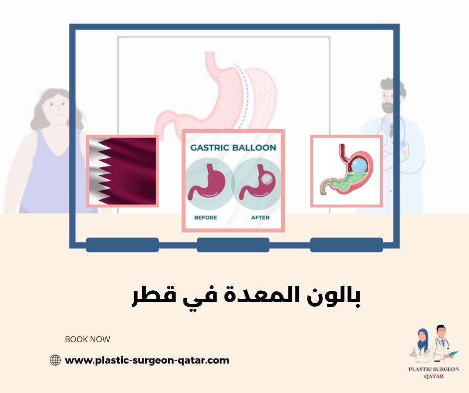 بالون المعدة في قطر بالون المعدة في قطر