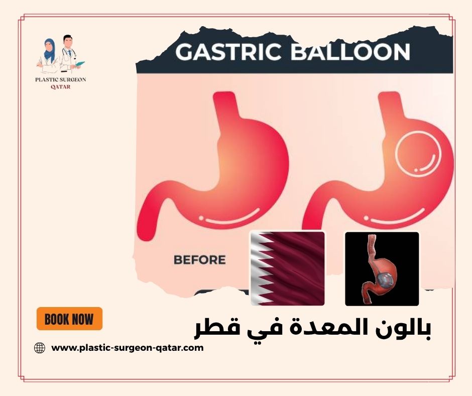 بالون المعدة في قطر بالون المعدة في قطر