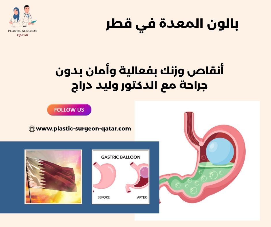 بالون المعدة في قطر