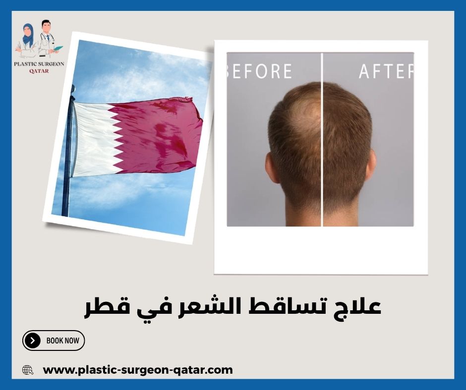 علاج تساقط الشعر في قطر
