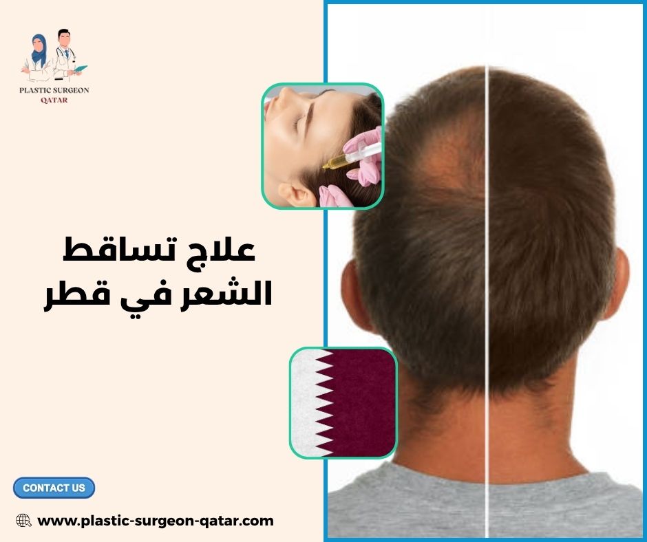 علاج تساقط الشعر في قطر