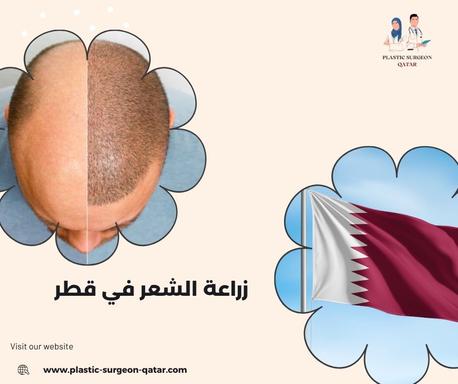 زراعة الشعر في قطر