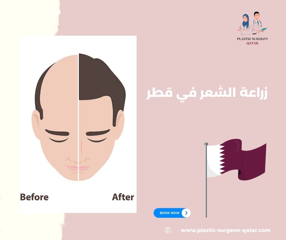 زراعة الشعر في قطر
