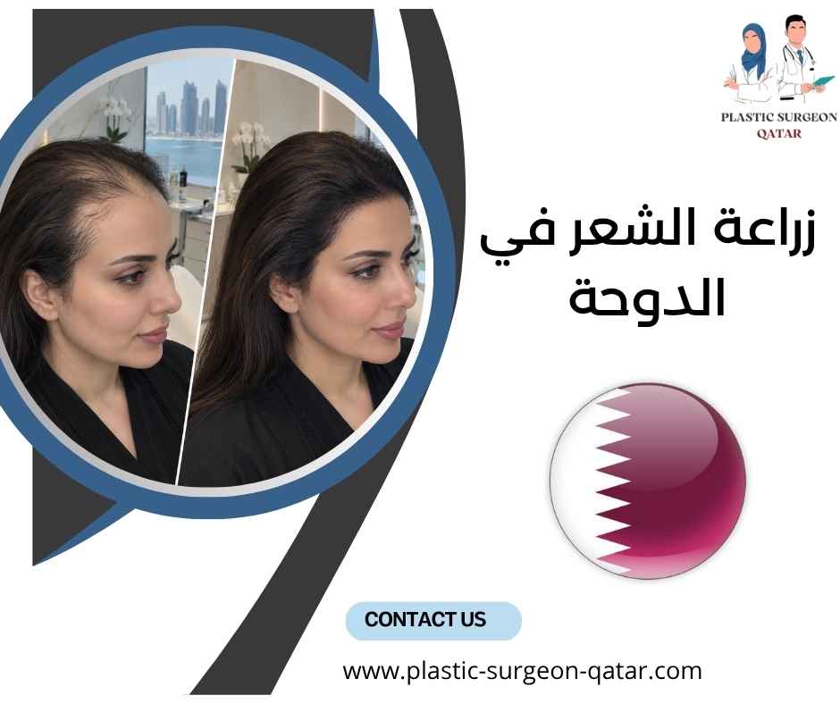 زراعة الشعر في الدوحة 