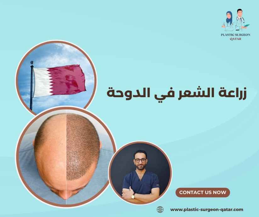 زراعة الشعر في الدوحة